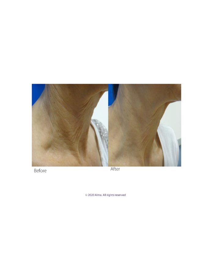 Clear Lift Skin Tightening | Skin Deep Midtown Med Spa.