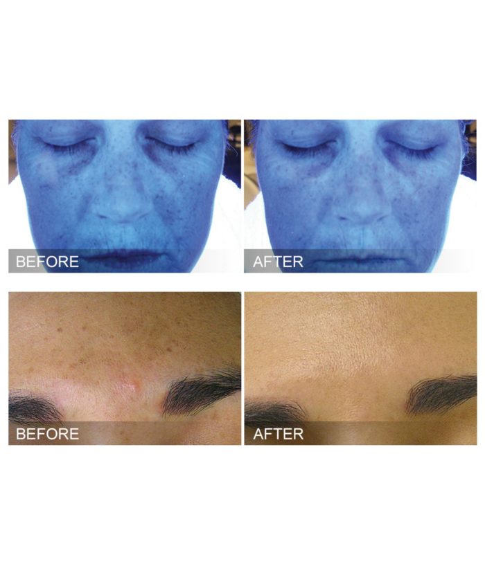 Hydrafacials | Skin Deep Midtown Med Spa.