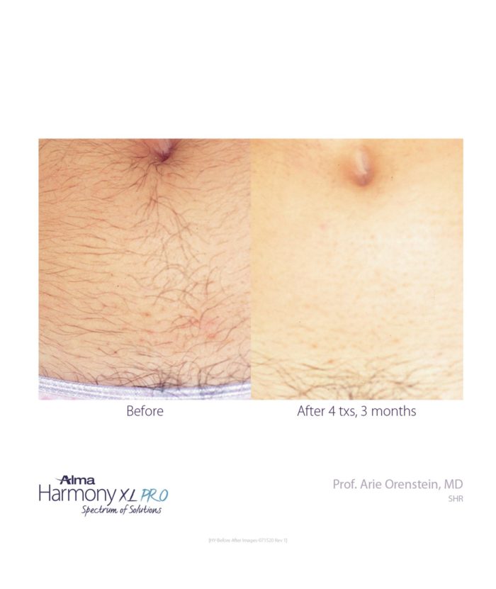 Laser Hair Removal | Skin Deep Midtown Med Spa.