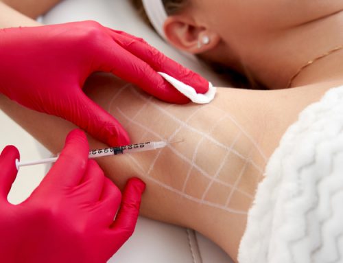 Does Botox Help With Sweating?