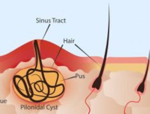 Choosing the Right Surgeon for Pilonidal Cyst Excision: Key Questions to Ask